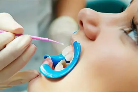 Restoration of tooth enamel