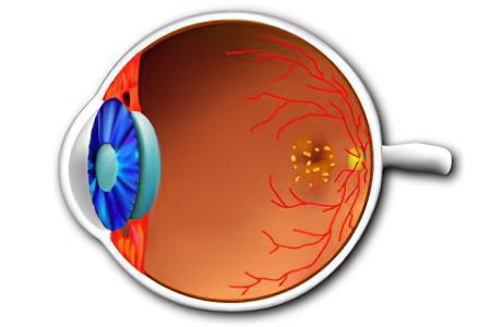 retinal dystrophy