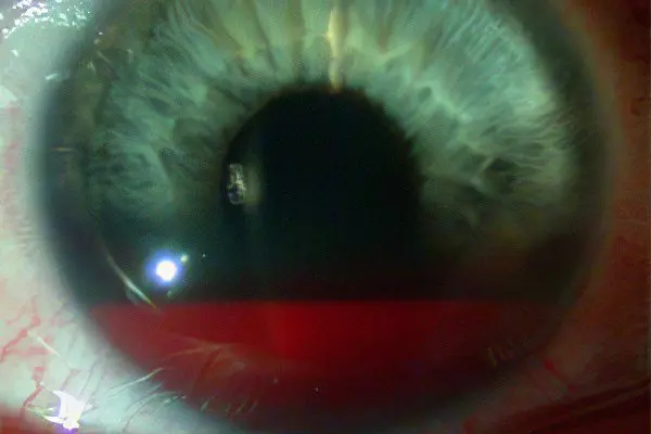 Retinal hemorrhage