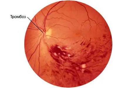 retinal thrombosis