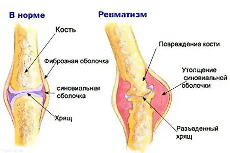 Rheumatism of the joints: symptoms and causes, how to treat rheumatism?