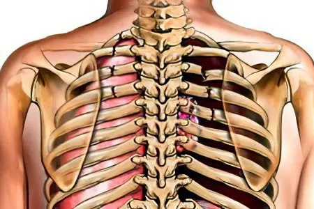 Rib fracture: symptoms, classification and treatment