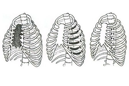 Rib fracture: symptoms, classification and treatment