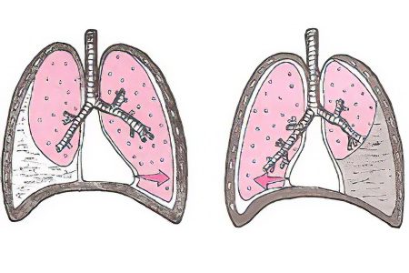 Right-sided and left-sided hydrothorax of the lungs