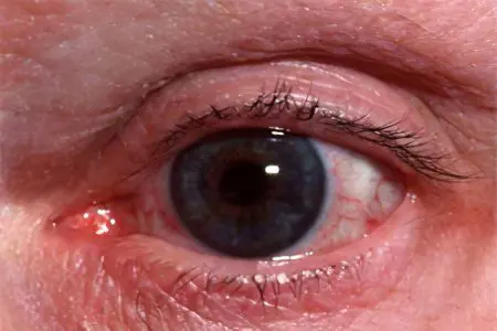 Rosacea of ​​the eye: what to do?