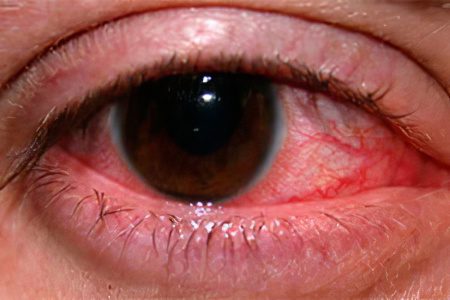 Rosacea of ​​the eye: what to do?