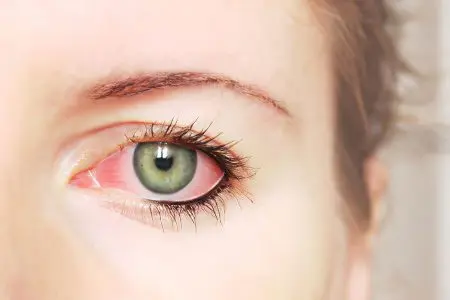 Rosacea of ​​the eye: what to do?