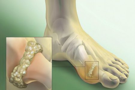 Salt deposits in the joints