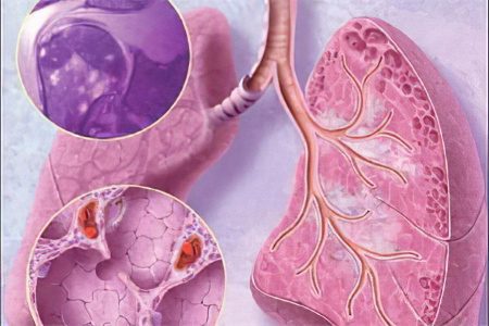 Sarcoidosis of the lungs: causes, symptoms and treatment