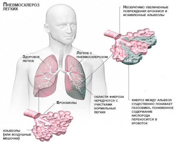 Sarcoidosis of the lungs: causes, symptoms and treatment