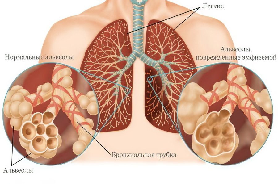 Sarcoidosis of the lungs: causes, symptoms and treatment