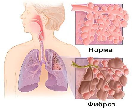 Sarcoidosis of the lungs: causes, symptoms and treatment