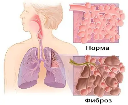 Sarcoidosis of the lungs: causes, symptoms and treatment