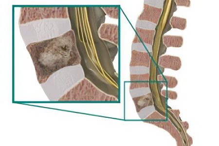 Sarcoma of the spine