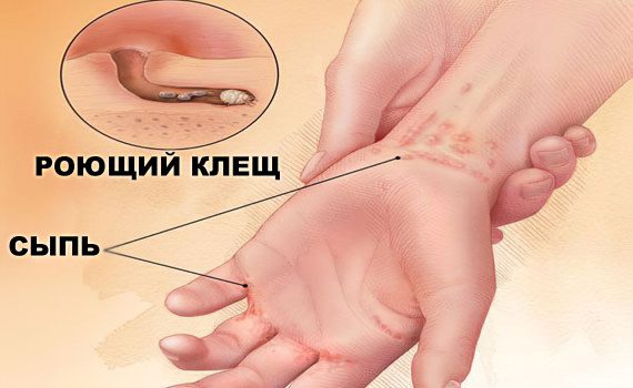 Scabies: types, symptoms, causes and treatment