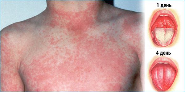 Scarlet fever in adults