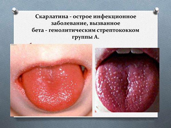 Scarlet fever in adults