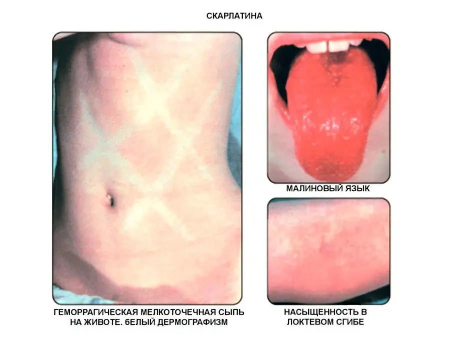 Scarlet fever in adults