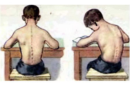 Scoliosis of the chest