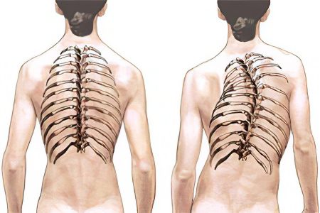 Scoliosis of the chest