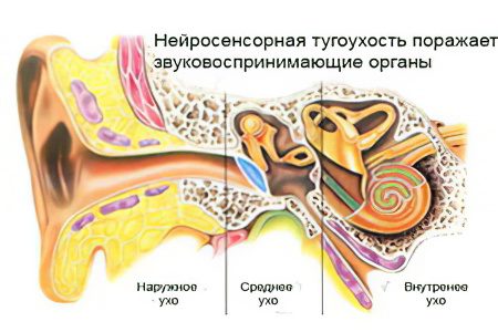 Sensorineural hearing loss