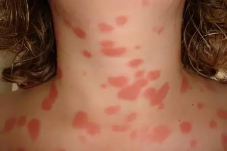 Severe itching of the skin of the body