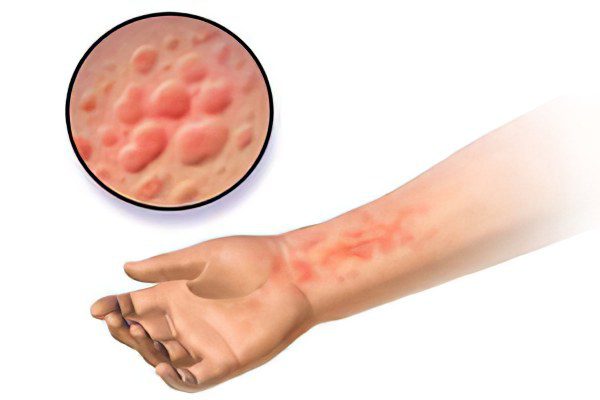 Severe itching of the skin of the body