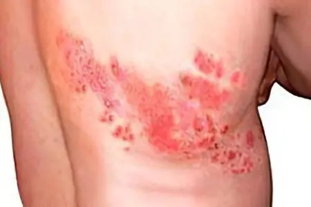 Shingles Herpes