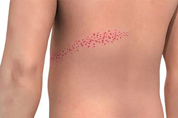 Shingles Herpes