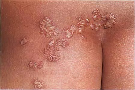 Shingles Herpes