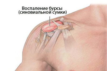 Shoulder bursitis