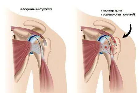 Shoulder-shoulder periarthritis