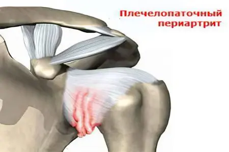 Shoulder-shoulder periarthritis