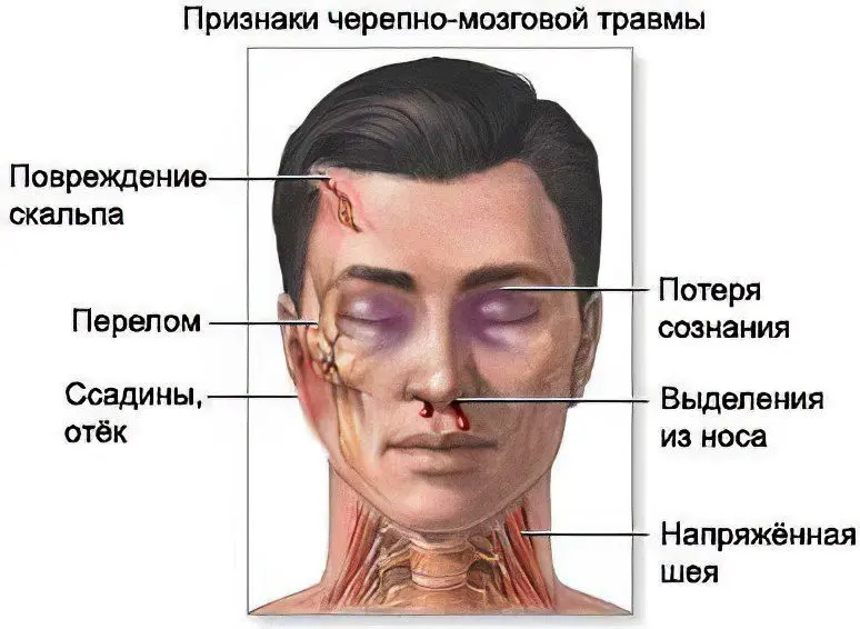 Signs and symptoms of a concussion in an adult
