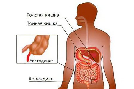 Signs and symptoms of acute and chronic appendicitis