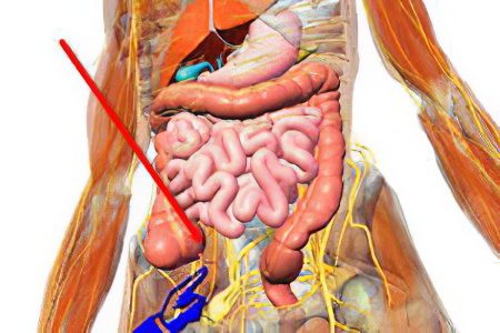 Signs and symptoms of acute and chronic appendicitis