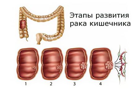 Signs, symptoms, stages and treatment of bowel cancer