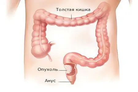 Signs, symptoms, stages and treatment of bowel cancer