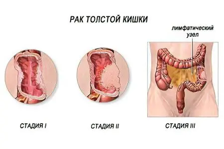 Signs, symptoms, stages and treatment of bowel cancer