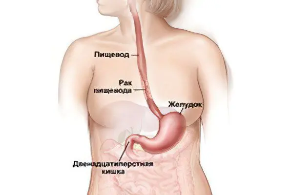 Signs, symptoms, stages and treatment of esophageal cancer