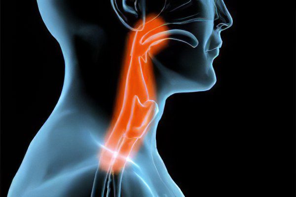 Signs, symptoms, stages and treatment of esophageal cancer