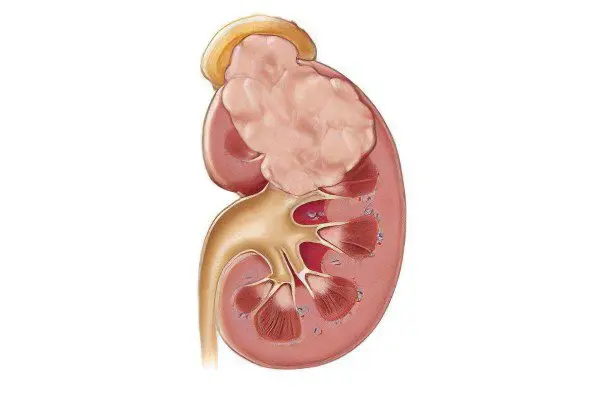 Signs, symptoms, stages and treatment of kidney cancer