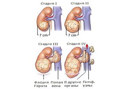 Signs, symptoms, stages and treatment of kidney cancer
