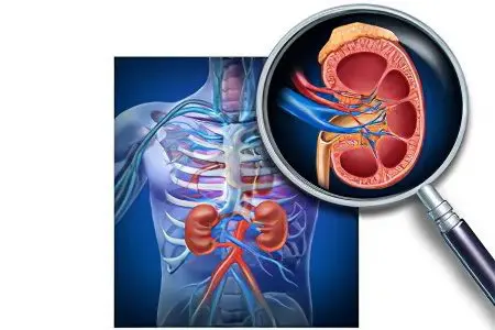 Signs, symptoms, stages and treatment of kidney cancer