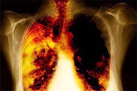 Signs, symptoms, stages and treatment of lung cancer