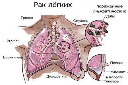 Signs, symptoms, stages and treatment of lung cancer