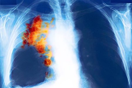 Signs, symptoms, stages and treatment of lung cancer