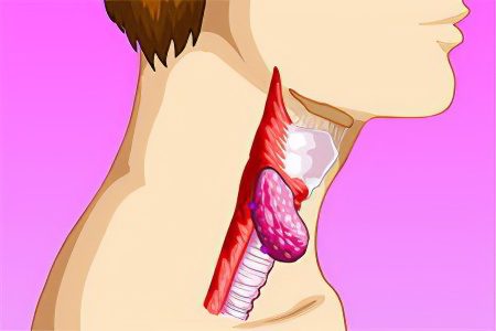 Signs, symptoms, stages and treatment of throat cancer