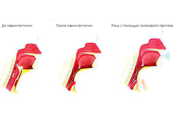 Signs, symptoms, stages and treatment of throat cancer