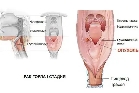 Signs, symptoms, stages and treatment of throat cancer